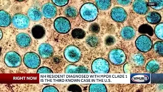 New Hampshire resident diagnosed with third case of clade I mpox in United States