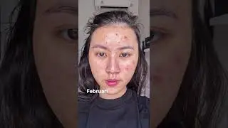 Beginilah kalau punya kulit Acne-Prone Skin🙈