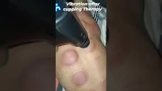 vibration therapy after cupping #physiotherapy #first momentum physiotherapy clinic 🦿🦿🦾🦾❤️