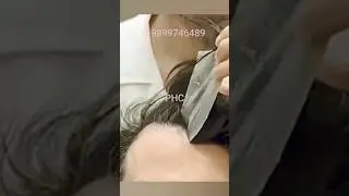best frontline hair patch price| Natural front line hair patches for men #hairpatch #hairreplacement