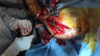 Segmental humerus fracture open reduction internal fixation - Dr. Lee