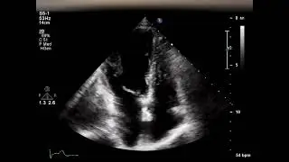 [Echo Case Review]small supracristal vsd
