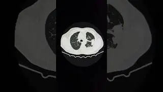 😱pleural effusion noted on (HRCT CHEST)|#hrct #radiology #viral #radiologyeducation #ct #shorts