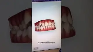 Исправление прикуса на элайнерах Invisalign - #здоровыезубы