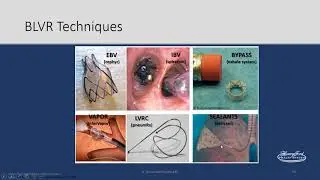 Bronchoscopic Management of COPD
