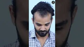 Best Hair Transplant Clinic In Gurugram: The Truth | IFT Hair Science