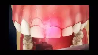 Hard Tissue Gingectomy