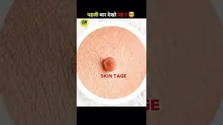 Skin tage कभी मत निकालना ❌Never Remove Skin Tag ||#shorts