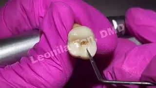 23 24 ENDO ACCESS PREP 3 MAXILLARY MOLAR