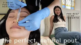 i got lip filler in toronto 2022 | natural plump lips 👄💉