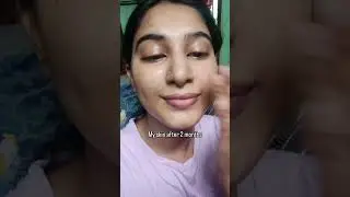 Say bye to your Acne and Blackheads with Proskire 2% Salicylic Acid Face Serum | Control Excess Oil