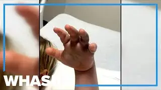 Copperhead snake bites child at North Carolina day care