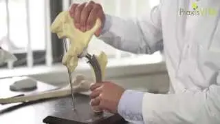 Wie sieht eine k&uuml;nstliche H&uuml;fte aus?