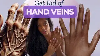 How to Get Rid of Hand Veins | Anti- Aging Secrets