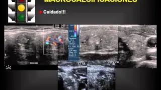 NODULO TIROIDEO