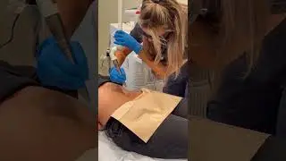 Abdomen tightening with Fotona TighthSculpting #fotona #tightsculpting #abs