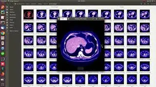 Classification & Segmentation of Kidney Tumor | UNET Resnet PyTorch| +91-7973788405 for query