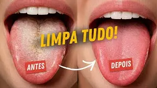 COMO ACABAR COM A L&Iacute;NGUA BRANCA e SABURRA LINGUAL? Dicas 