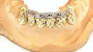 How to Cover Crooked Teeth With Grillz?