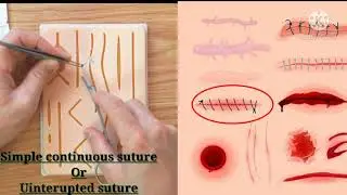 Suture techniques and simple continuous or uninterrupted suturing. How to become a surefire expert