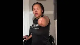 ooe amputee