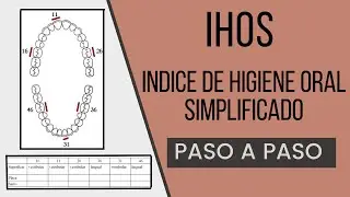 Indice IHOS | Indice de Higiene Oral Simplificado | Odontolog&iacute;a Con Cri