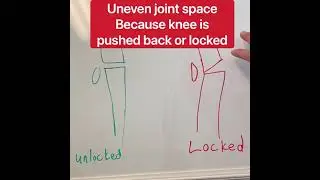 Poor Posture leads to knee pain