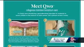 Treatment targets underlying cause of cellulite