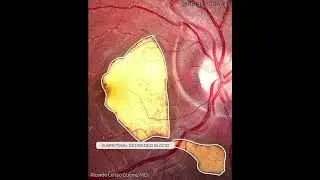 Choroidal Rupture - Multimodal Imaging Analysis