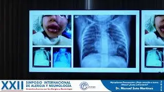 Mycoplasma Pneumoniae: &iquest;Viejo conocido o nuevo villano? &iquest;Como enfrentarlo?