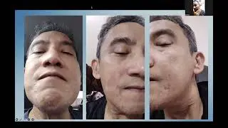 TARI #127: Clinton - Alergi Teratasi Berkat, Renu28, RenuAdvanced & Intensive Redox Serum