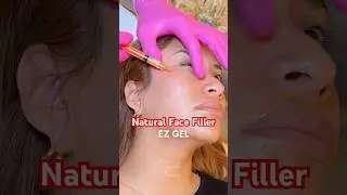 EZ GEL PRF: натуральный наполнитель из вашей крови? | Результаты исследований в Ньюпорт-Бич