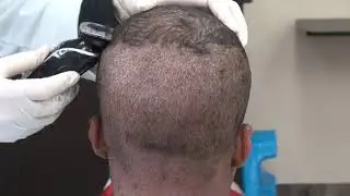 FUE Scar Hair Transplant Long & Short Hair Minimal Scars Surgery Dr. Diep  