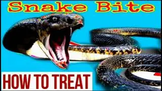 Management of snake bite | Treatment | #AFMC Doctor Interview l Interview Guide