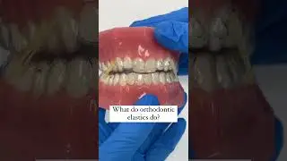 Maria shows how orthodontic elastics can be used during clear aligner treatment