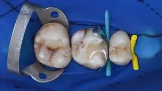 Tetric PowerFill & Tetric PowerFlow | EN | Ivoclar