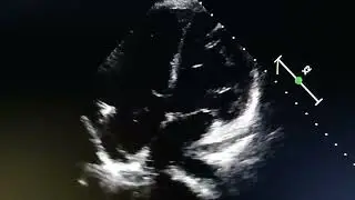 Chiari network in the right atrium.Normal anatomical variant.