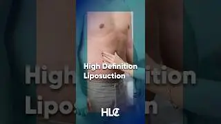 HİGH DEFINITION LIPOSUCTION
