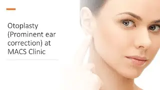 Bilateral Otoplasty (Prominent ear correction) procedure performed under local anaesthetics.