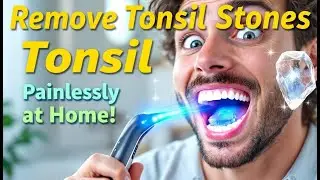 Remove Tonsil Stones Painlessly at Home! 💡