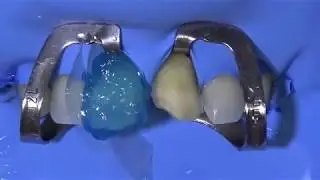 15.7 Cementado de Carillas