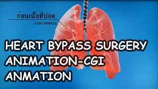 Heart bypass surgery || 3D CGI Animation || Medical Animation