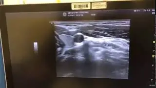 Cervical Sympathetic Chain- Stellate Ganglion Block using Ultrasound