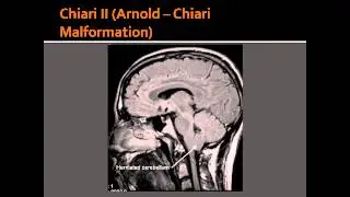 Chiari II ( Arnold-Chiari Malformation ) & Dandy-Walker Syndrome