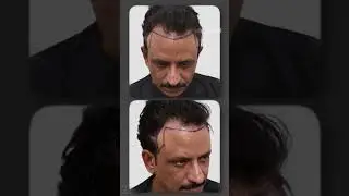 Bollywood Actor Rajesh Tailang&rsquo;s Hair Transplant Journey at Skinroots Clinic