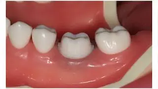 MANI DIA-BURS molar tooth preparation