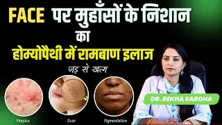 Homeopathy for Acne & Scars | Get Glowing, Scar-Free Skin Naturally | Dr. Rekha Saroha