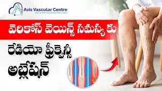Radiofrequency Ablation Explained | Dr. Soujanya | Avis Hospitals