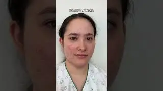 ✨ Linnea&rsquo;s V-line Surgery Part 2 is HERE! ✨