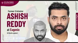 Why Former Cricketer Ashish Reddy Chose Eugenix for His Hair Transplant | Testimonial